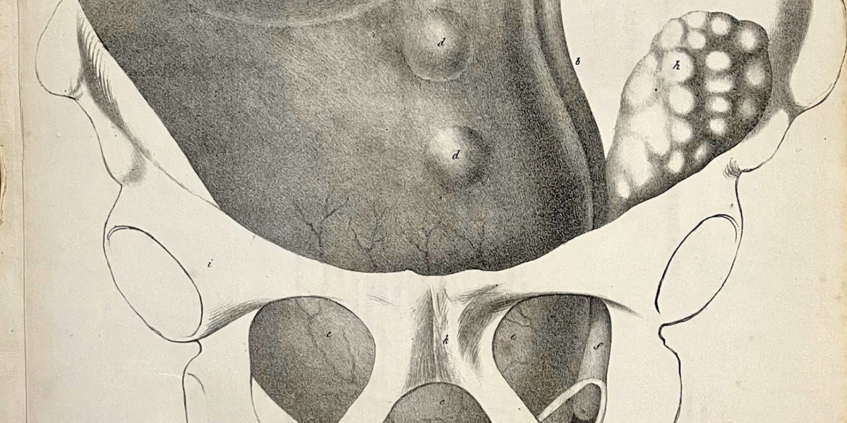 Color photo of a black and white illustration of a diseased uterus in Marie Anne Boivin's Practical Treatise of the Diseases of the Uterus and of its Annexes, 1834.
