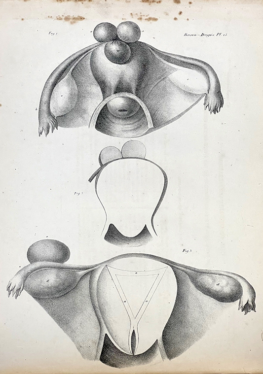 Color photo of a black and white illustration of diseased uteri in Marie Anne Boivin's Practical Treatise of the Diseases of the Uterus and of its Annexes, 1834.