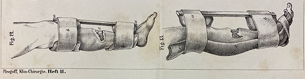 Two black and white images of set leg wounds from Pirogov's Klinischechirurgie, 1854.