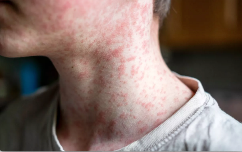 Example of measles on a person