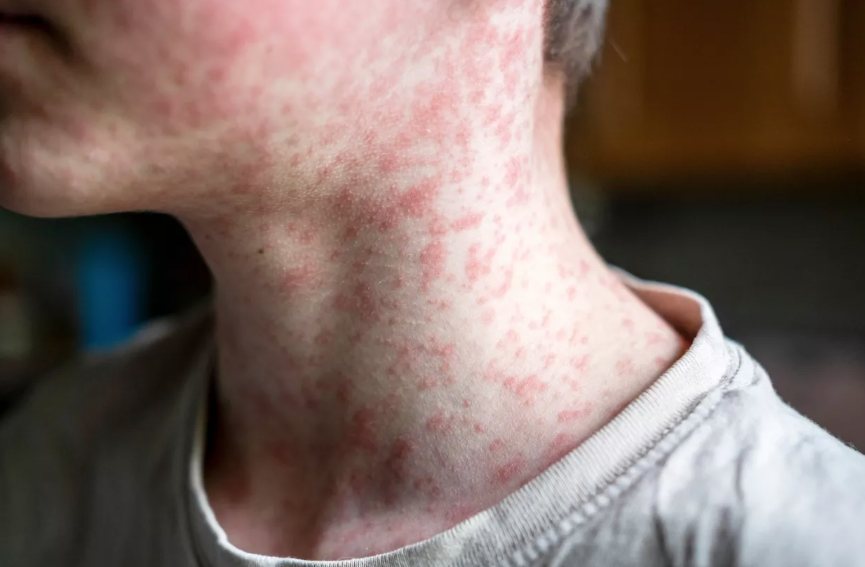 Example of a person with measles symptoms 